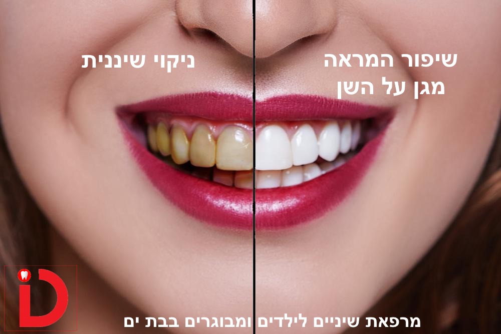 ניקוי ומניעה